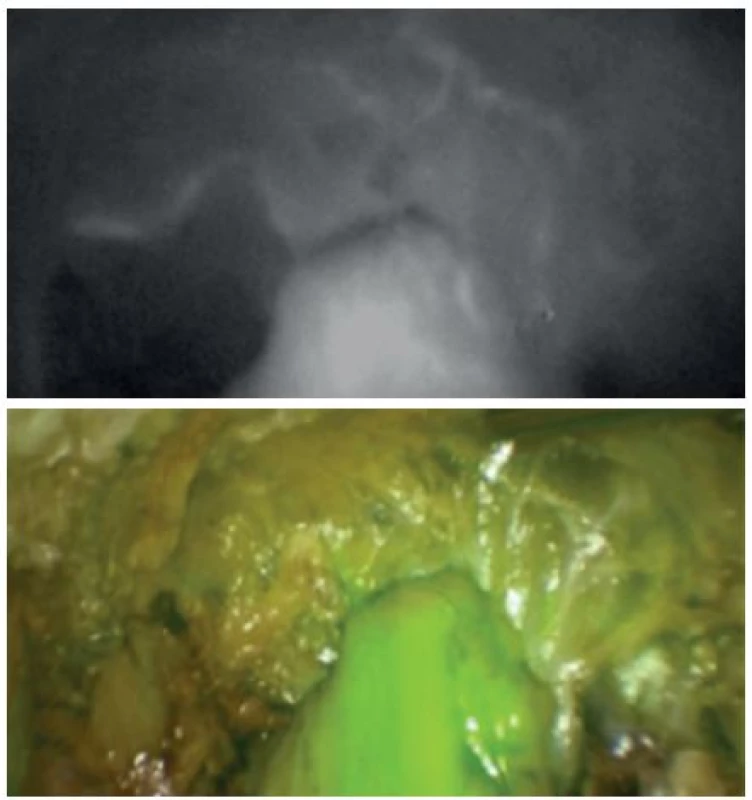 Obraz NIR fluorescentní angiografie a superponovaný obraz v normálním světle
Fig. 2: NIR perfusion assessment and superposition of NIR and normal light