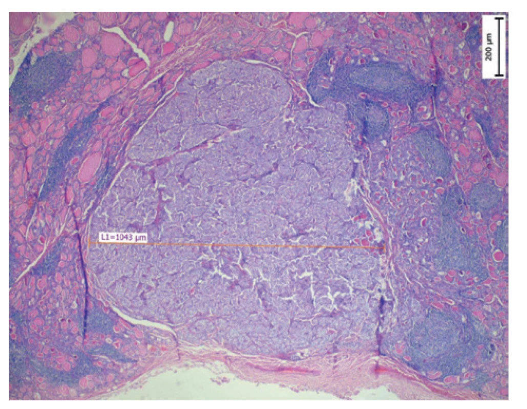 Papilární mikrokarcinom (MPTC) o velikosti 1 mm<br>
Fig. 1: Papillary microcarcinoma with the diameter of 1mm