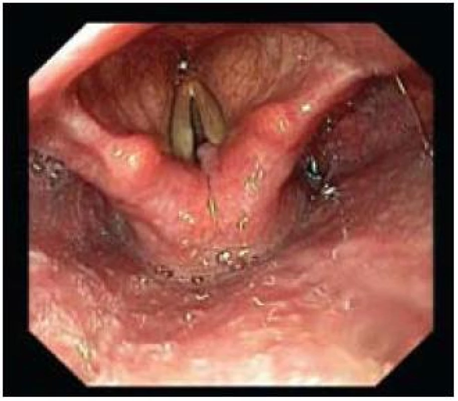 Granulom pravé hlasivky.
Fig. 8. Granuloma of the right vocal cord.