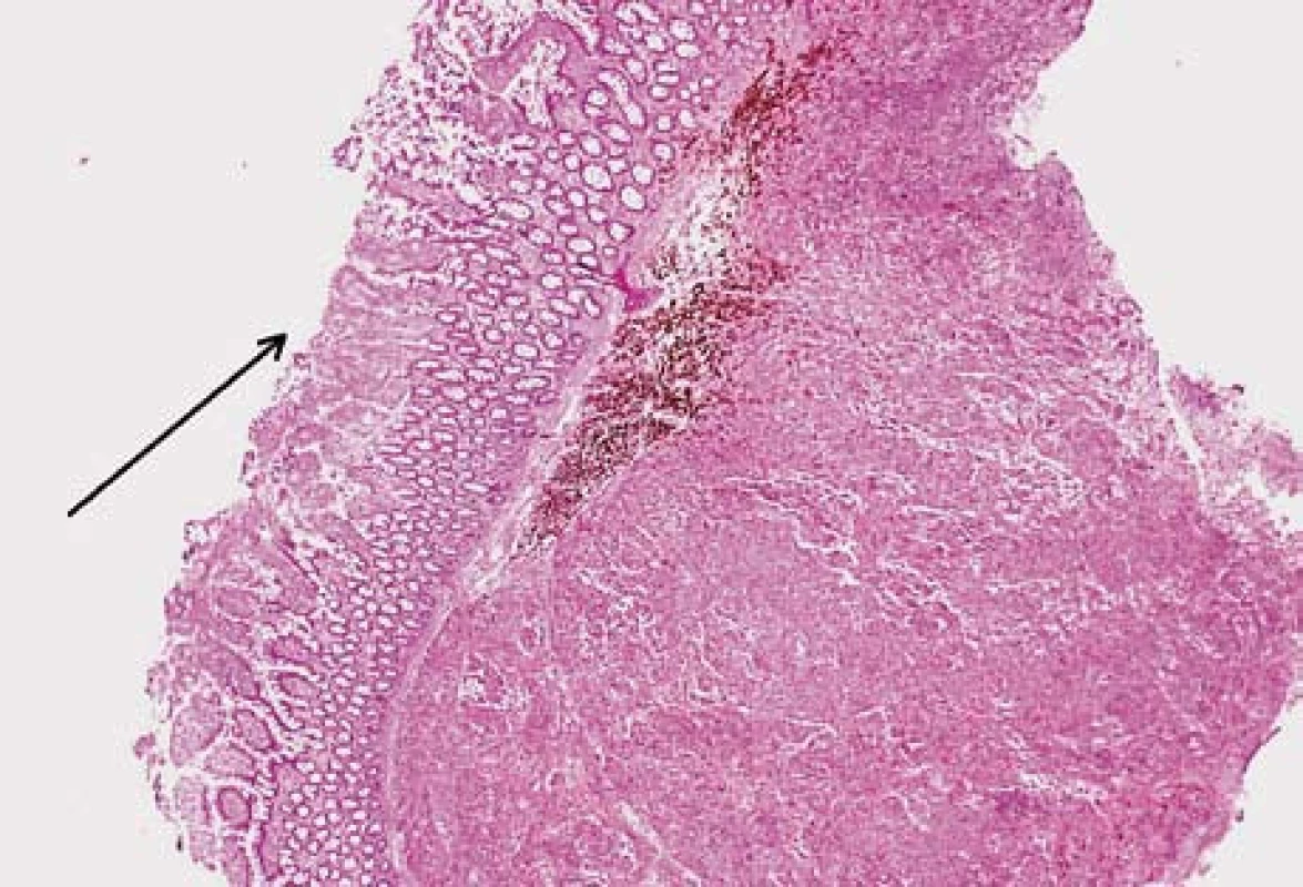 Submukózní ložisko metastázy melanomu. Na povrchu ulcerovaná sliznice tenkého střeva (šipka). Hematoxilin-eozin.
Fig. 5. Submucosal melanom metastasis. Ulcerated small bowell mucosa (arrow). Hematoxilin-eosin staning.
