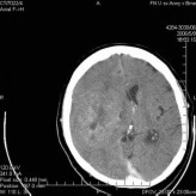 CT mozku s aplikaci k.l., předoperační, axiální řez. Nehomogenní,postkontrastně se nepravidelně vysycující infiltrace s kalcifikacemi.