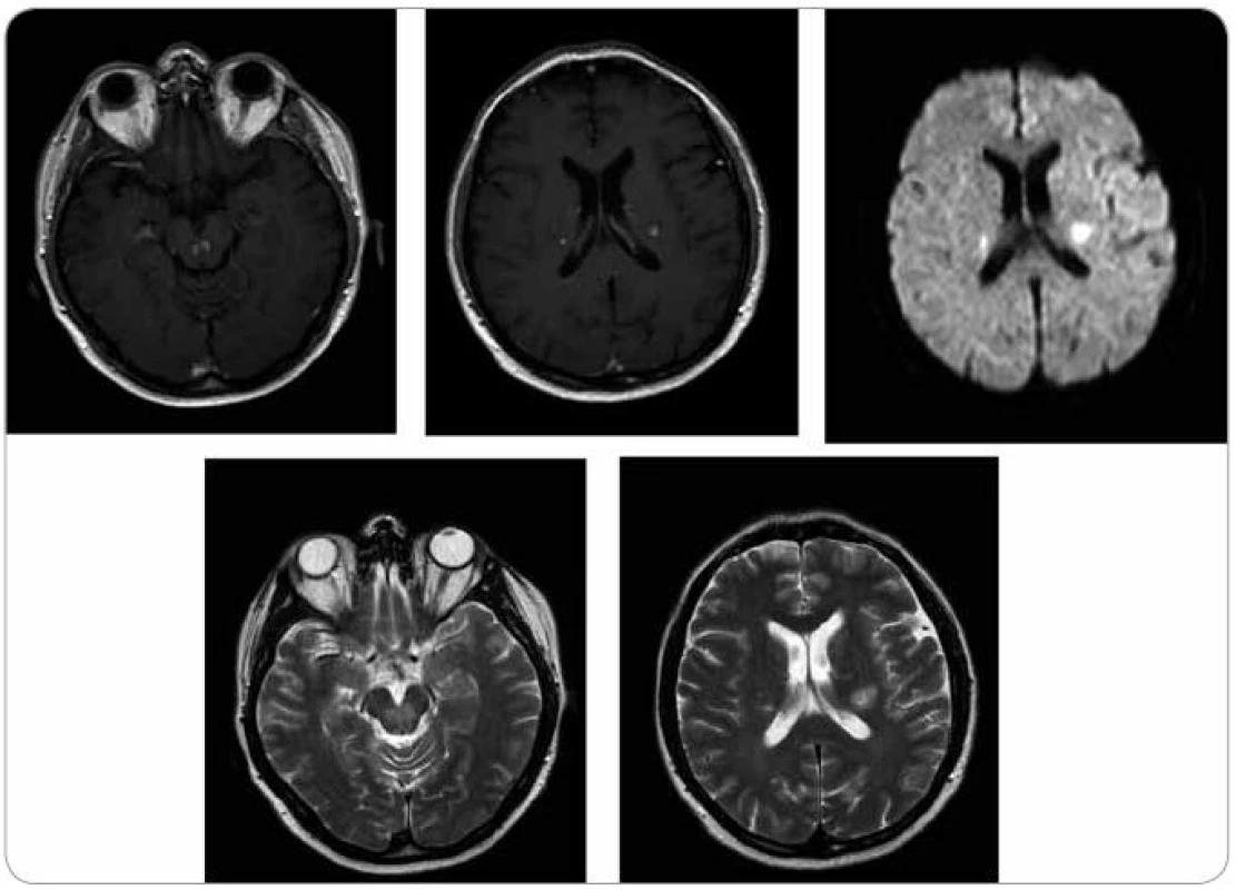 MR zobrazení mozku z 28. 5. 2009. Pokud považujeme první vyšetření (22. 1. 2009) jako vyšetření referenční před léčbou, pak se na první kontrole v průběhu léčby (28. 5. 2009) obraz nijak nemění, velikost i sycení ložisek infra i supratentoriálně je stejné.