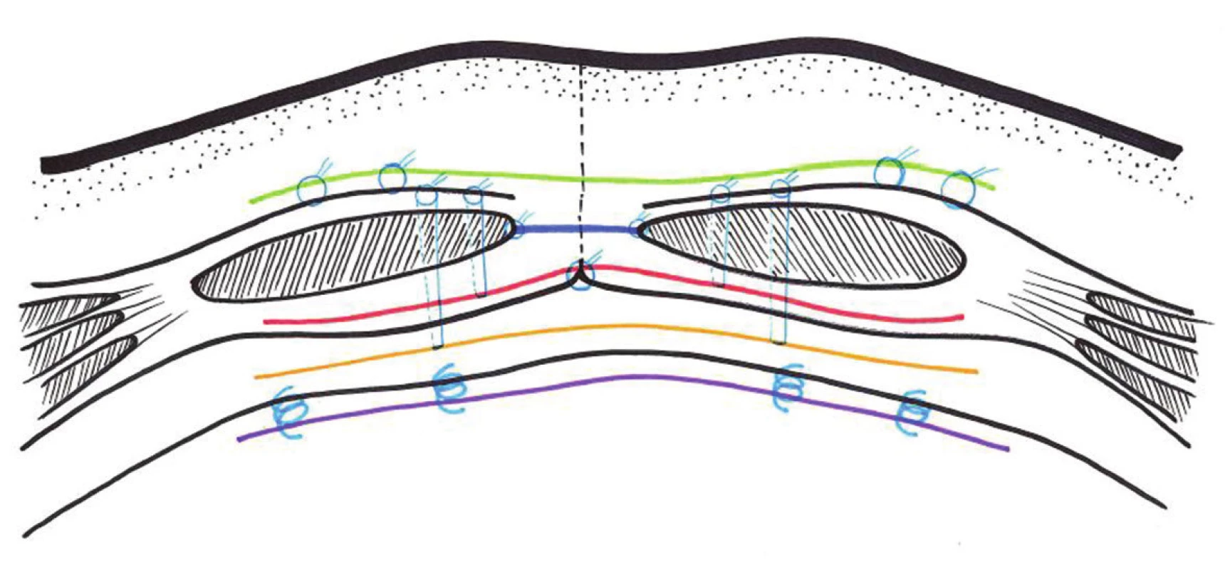 Schéma pozice a kotvení síťky při plastikách:
Onlay (zeleně), inlay (modře), underlay – retromuskulárně (červeně), sublay – preperitoneálně (žlutě), IPOM (fialově)
Fig. 12: Scheme of the position and anchoring of the mesh in hernioplasty:
Onlay (green), inlay (blue), underlay-retromuscular (red), sublay-preperitoneal (yellow), IPOM (purple) (red), sublay-preperitoneal (yellow), IPOM (purple)