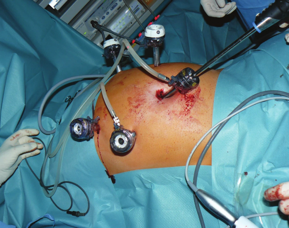 Operační nález: zavedené porty a optika při laparoskopické resekci žaludku