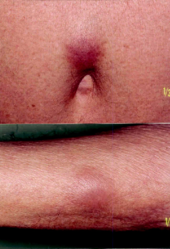 Nález podkožných uzlov pri pupku a na zadnej strane pravého predlaktia v januári 2007 pred zahájením chemoterapie.