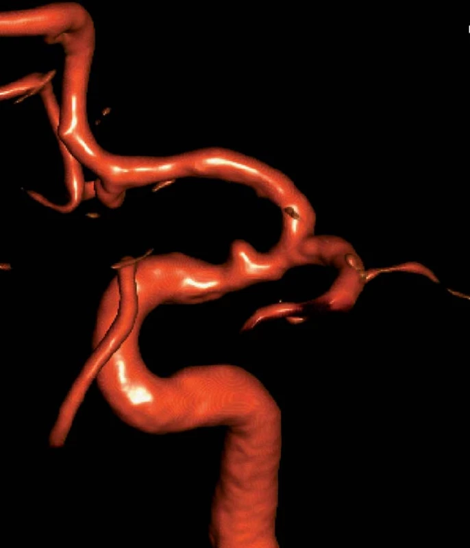 Angiografie ukazuje drobné aneuryzma na spastickém supraklinoidním segmentu ACI.