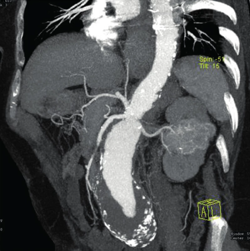 Juxtarenální aneuryzma břišní aorty a renální karcinom střední části levé ledviny
Fig. 2: Juxtarenal abdominal aortic aneurysm and renal carcinoma of the middle part of the left kidney