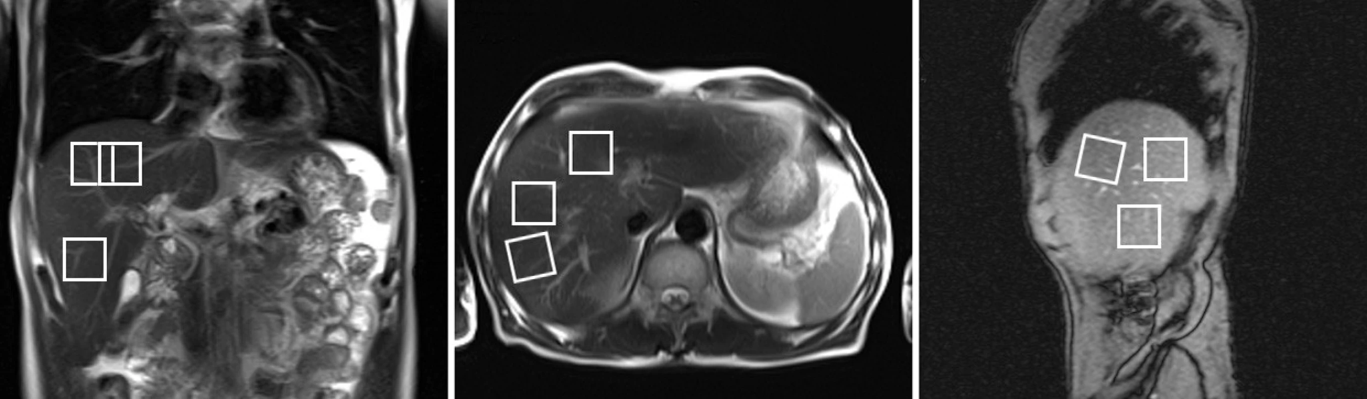 Umístění tří vyšetřovaných objemů VOI (27 ml) pro stanovení obsahu tuků v játrech 1H MR spektroskopií (pacient s nízkým obsahem tuku – stupeň S0)
