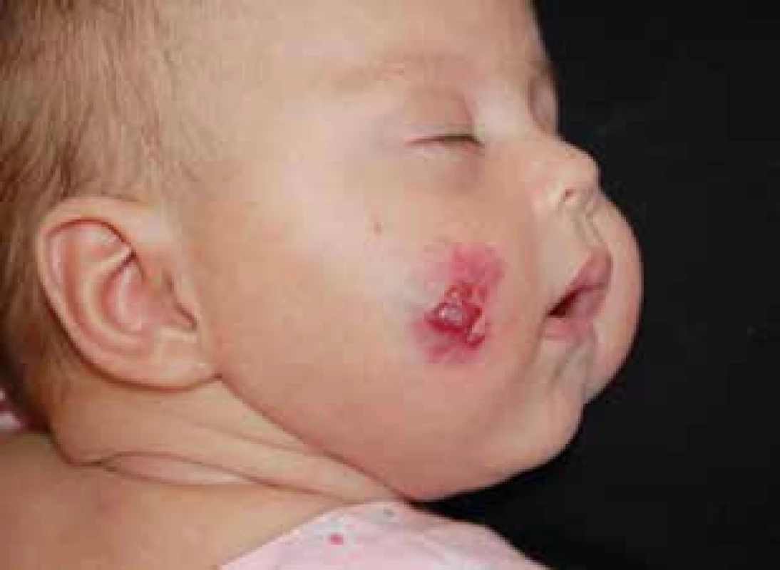 Smíšený infantilní hemangiom tváře.
Fig. 3. Mixed infantile hemangioma on the cheek.