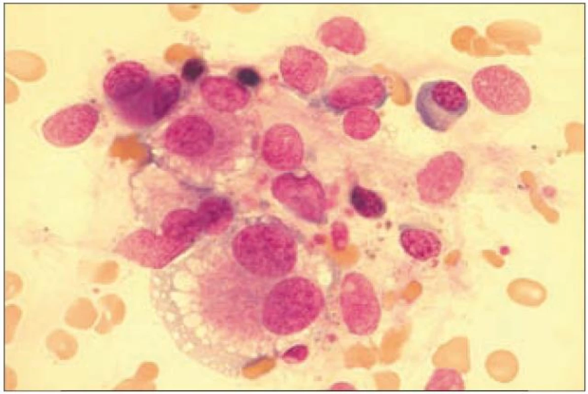Obraz hrubých dysplastických změn megakaryocytu u nemocné s MDS.