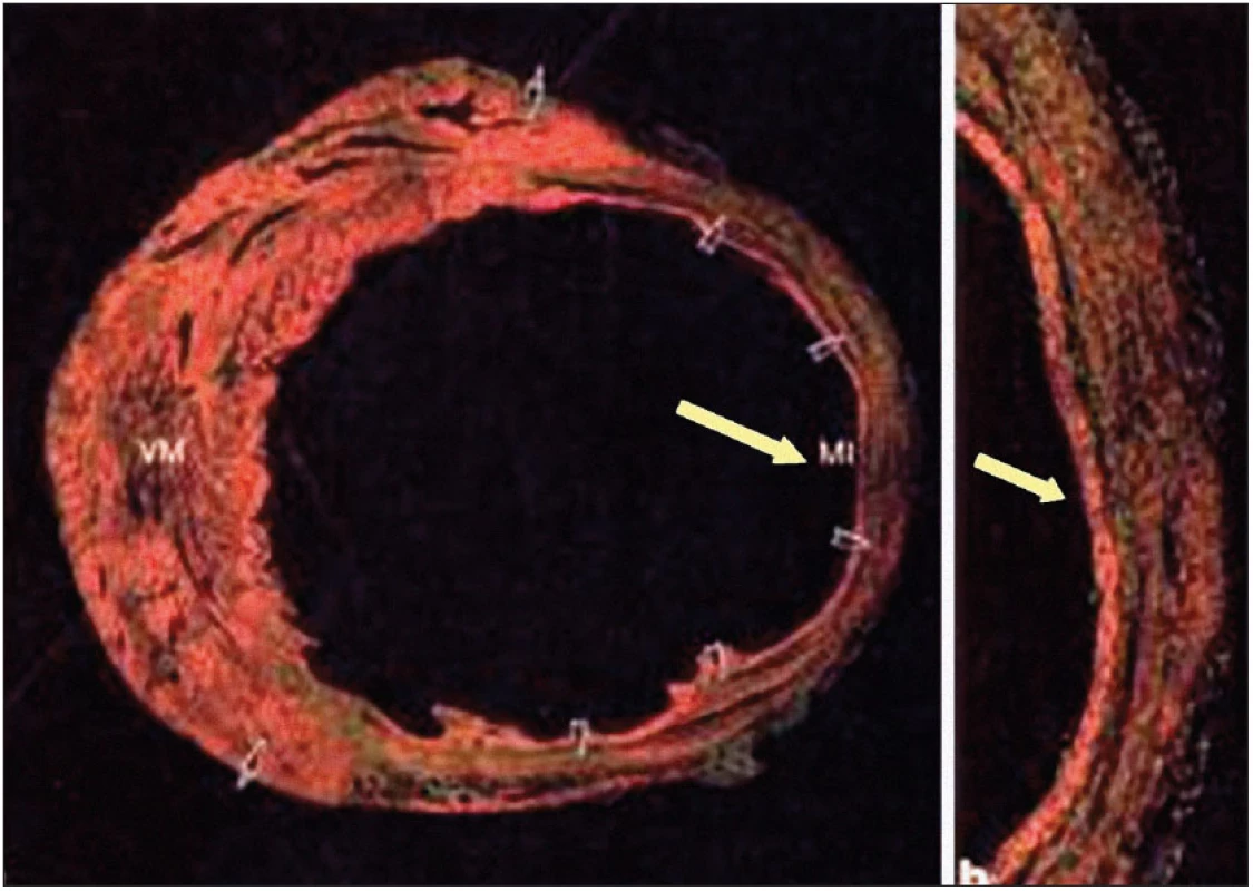 Regenerace myokardiální fibrotické jizvy u myších modelů po podání KB. Převzato z [16] se svolením D. Orlica.