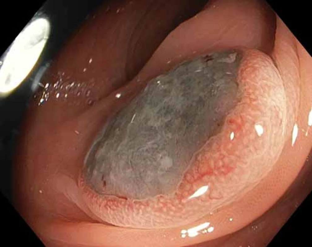 Léze vzhledu „volského oka“ velikosti 30 mm v tlustém střevě, ve zvětšení Near Focus.
Fig. 3. Bull’s eye lesion of the colon, 30 mm in diameter, magnified with Near Focus.