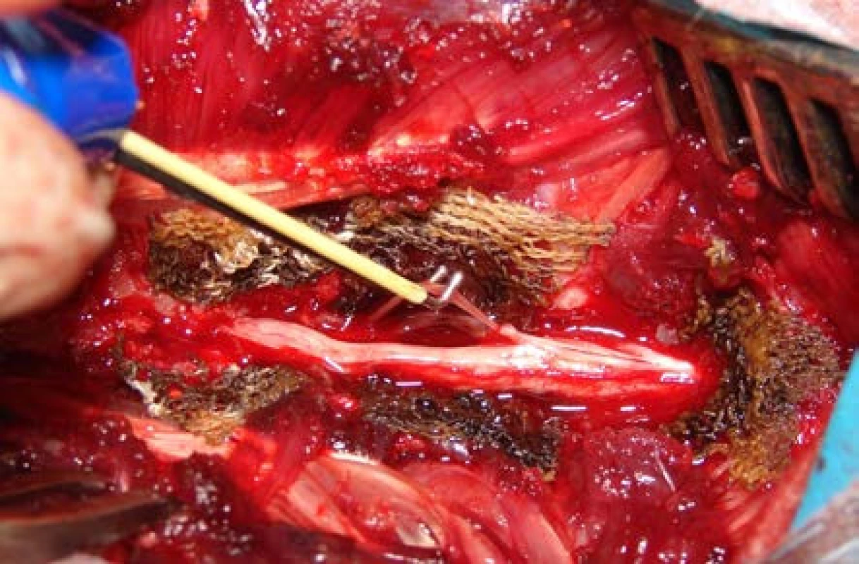 Peroperační foto – stimulace míšního kořene háčkovou elektrodou
Fig. 3. Intraoperative photo – ventral spinal root stimulation by hook electrode