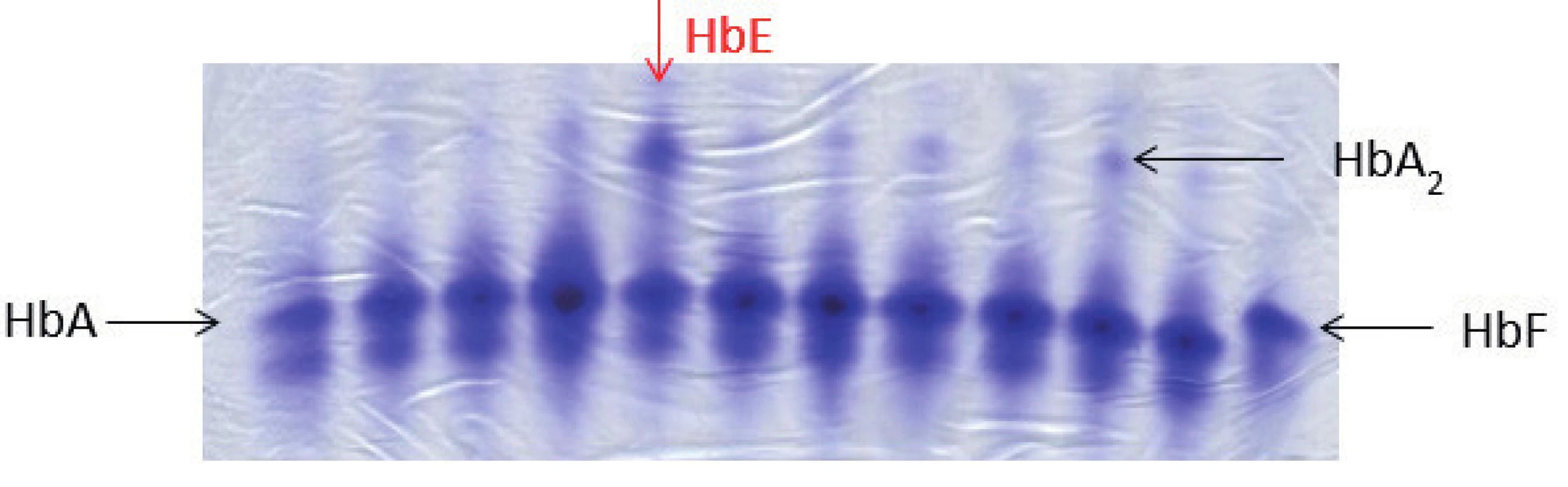 Elektroforéza Hb, polyakrylamidový gel barvený Coomasie blue. Na obrázku zobrazené jednotlivé frakce hemoglobinového spektra: HbA, HbF, u některých vzorků je patrná výrazněji frakce HbA₂, jedná se o nosiče β-talasemické alely. Červená šipka ukazuje pacienta s abnormálním hemoglobinovým spektrem, jedná se o nosiče alely pro HbE (hemoglobinová varianta s talasemickým fenotypem). HbE putuje stejnějako frakce HbA₂, k jeho potvrzení je nutná sekvenační analýza HBB genu. (M. Divoká, Hemato-onkologická klinika, FN a LF Univerzity Palackého v Olomouci)
Fig. 4. Hemoglobin electrophoresis in polyacrylamide gel stained with Coomasie blue. Hemoglobin electrophoresis showing the fractions of hemoglobin: HbA, HbF. More significant HbA₂ fraction in some samples demonstrates β-talasemia minor. The red arrow showing abnormal hemoglobin spectrum in a patient with hemoglobin E trait (hemoglobin variant with thalassemic phenotype). HbE fraction co-migrates with HbA₂. To confirm the Hb variant, HBB gene sequencing analysis is required.