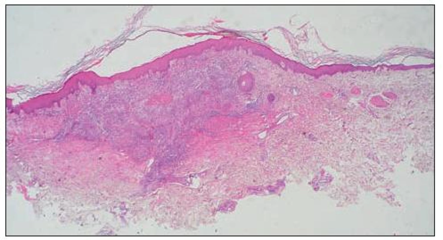 Histopatologický obraz EED (farbenie HE, zväčšenie 20x)