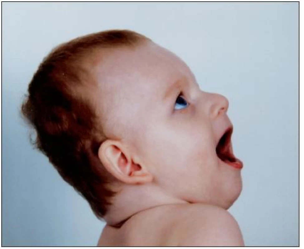 Typický fenotyp dítěte s Angelmanovým syndromem
(publikováno se svolením rodičů dítěte, fotoarchiv OLG Ostrava)