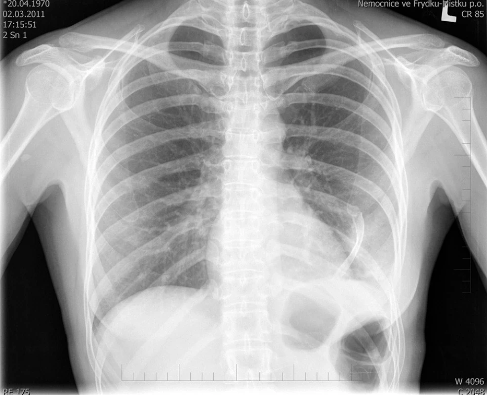 RTG plic po úrazu, patrná dislokace VIII. žebra vlevo, okraj fragmentu zlomeniny se promítá k srdečnímu hrotu 
Fig. 1. Posttraumatic lung x-ray, dislocation of the 8th rib on the left side. The rib fragment edge is located near the heart tip