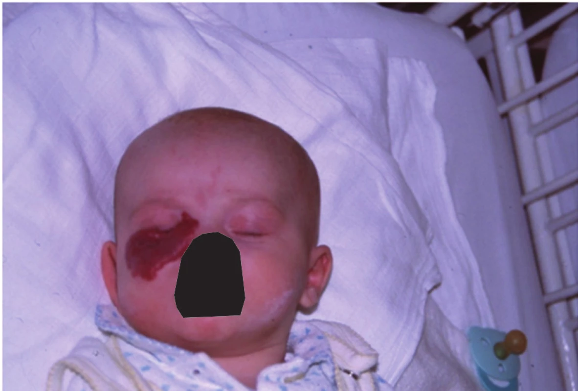 Kapilární hemangiom dolního víčka u tříměsíčního kojence