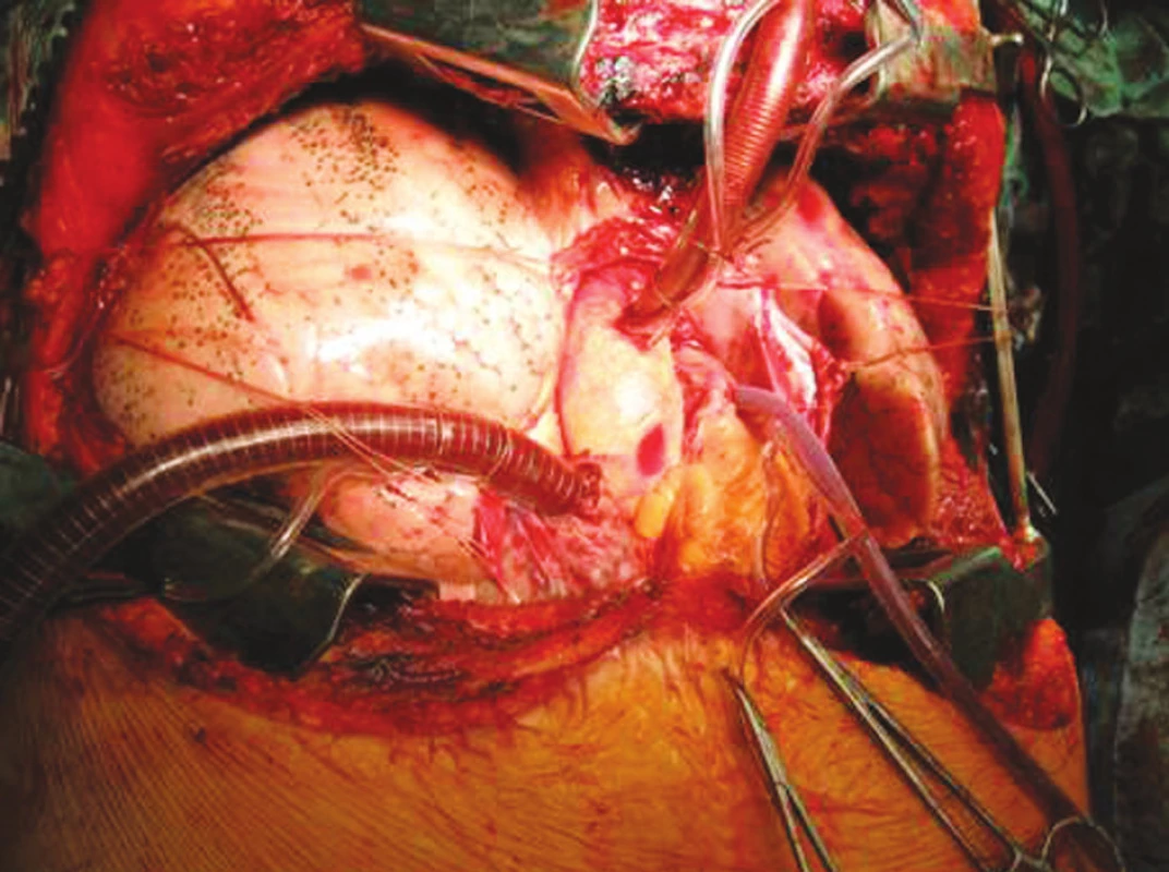 Technika transplantace plic, stav po implantací
Fig. 5.Lung tansplantation technique, the condition after the procedure