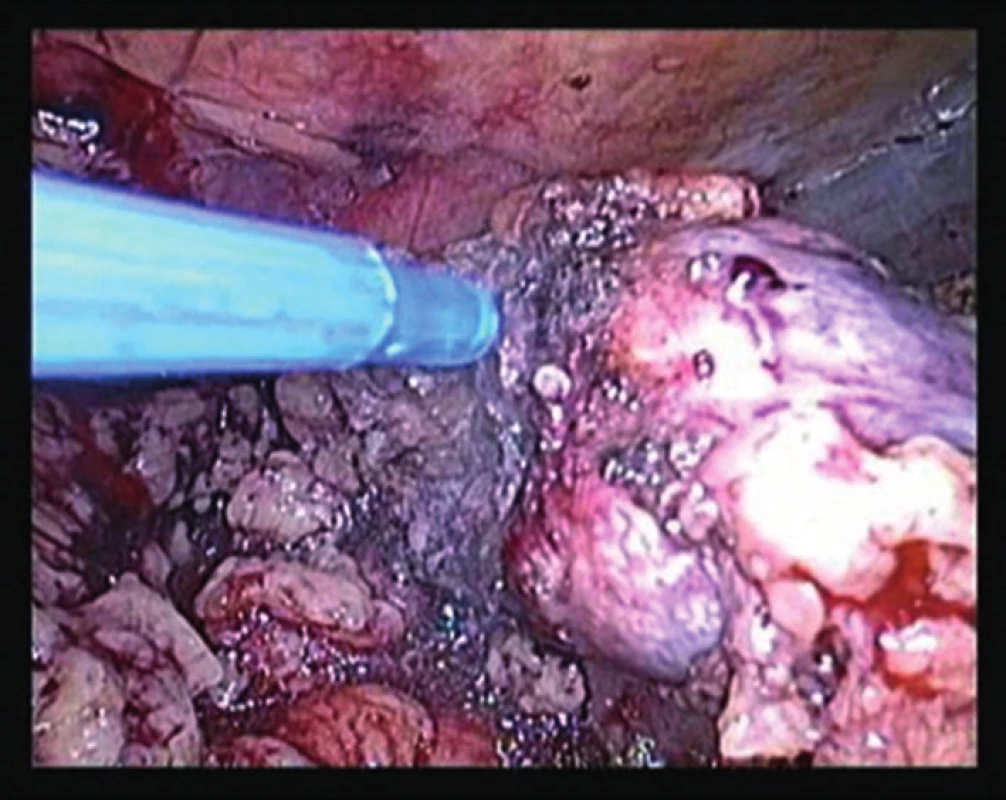 Aplikace tkáňového lepidla při laparoskopické resekci ledviny
Fig. 1: Tissue glue application in laparoscopic resection of the kidney