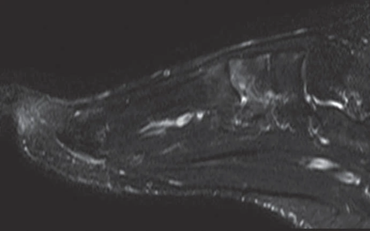 MRI nohy (červen roku 2012). Prokazatelný obraz nehomogenního edému v oblasti Lisfrankova kloubu, nejvýrazněji v os cuneiforme med. a v bázích I. a II. metatarzu (skvrnitě dekalcinovaná struktura a mnohočetná cystická projasnění v talu viditelná CT obraze, nejsou při MRI prokazatelná).