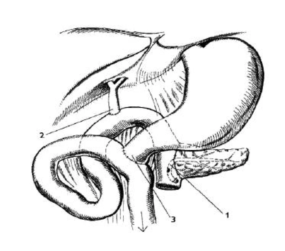 Pylorus záchovná duodenopankreatektómia podľa Traverso-Logmire
1 – pankreatikojejunoanastomóza, 2 – hepatikojejunoanastomóza asi 25 cm od pankreatikojejunoanastomózy, 3 – duodenum všité do odvodnej kľučky 40 cm distálnejšie, modifikované podľa Manna (52)