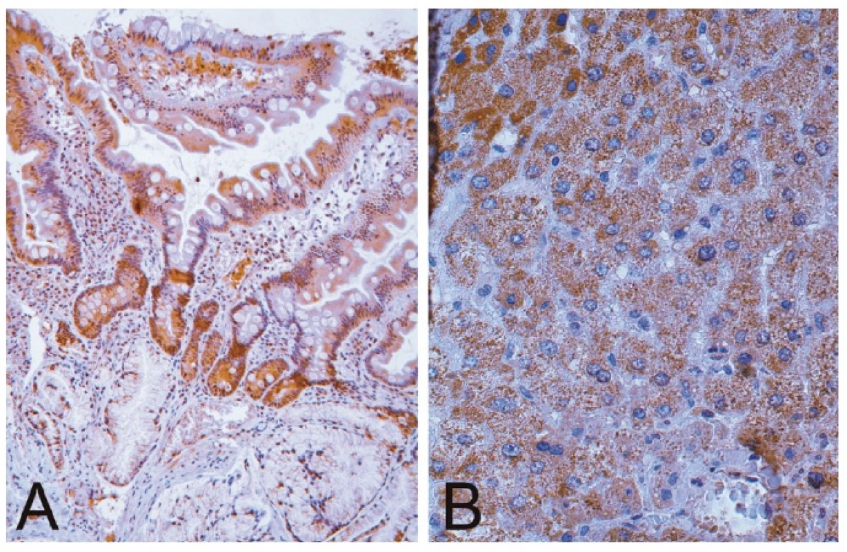 Type-1 adiponectin receptor in the small intestine (duodenum). The immunopositivity (brown color) is present in enterocytes and stromal cells (A). The immunopositivity of hepatocytes served as a positive control (B). Immunoperoxidase method, counterstained slightly by hematoxylin, original magnification 200x (A) and 400x (B).