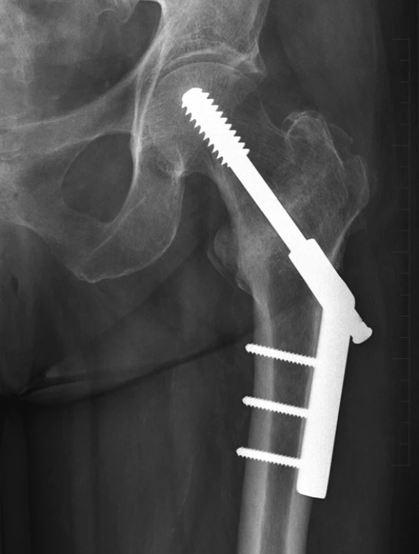 Stav po osteosyntéze stabilní pertrochanterické zlomeniny horního konce stehenní kosti pomocí systému DHS s 3-otvorovou dlahou, 6 měsíců po operaci s dobrým postavením. Předozadní RTG projekce. Zlomenina zhojena.