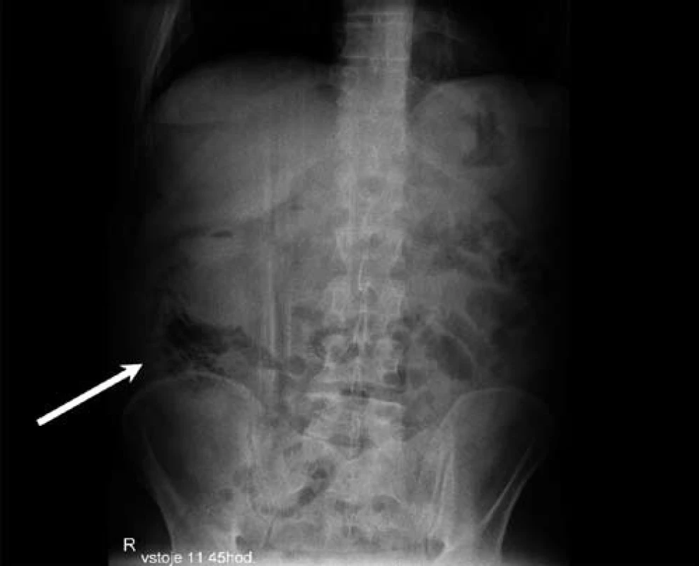 Nativní rentgenové vyšetření břicha – řetízkovitě uspořádaný plyn v pravém dolním břišním kvadrantu (bílá šipka), nejsou známky pneumoperitonea ani dilatace střeva.
Fig. 1. Native abdominal X-ray – gas arranged in chains in the bottom right abdominal square (white arrow), no traces of pneumoperitoneum or dilated intestine.
