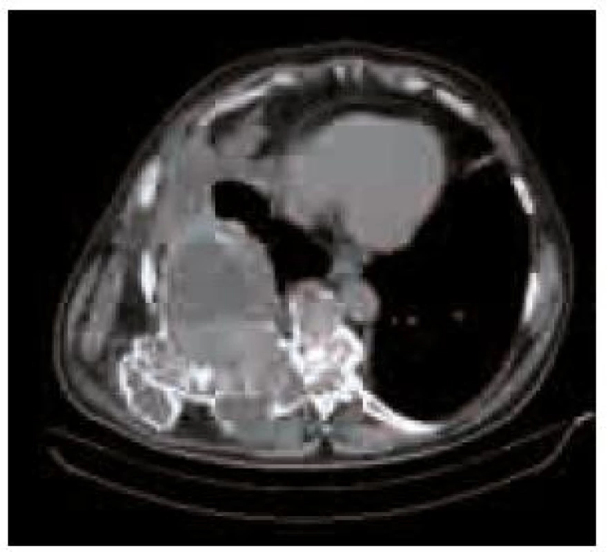 CT obraz fibrózní dysplazie s postižením hrudní stěny a těla 8. a 9. hrudního obratle s kompresí míchy v páteřním kanálu a útlakem plicního křídla.