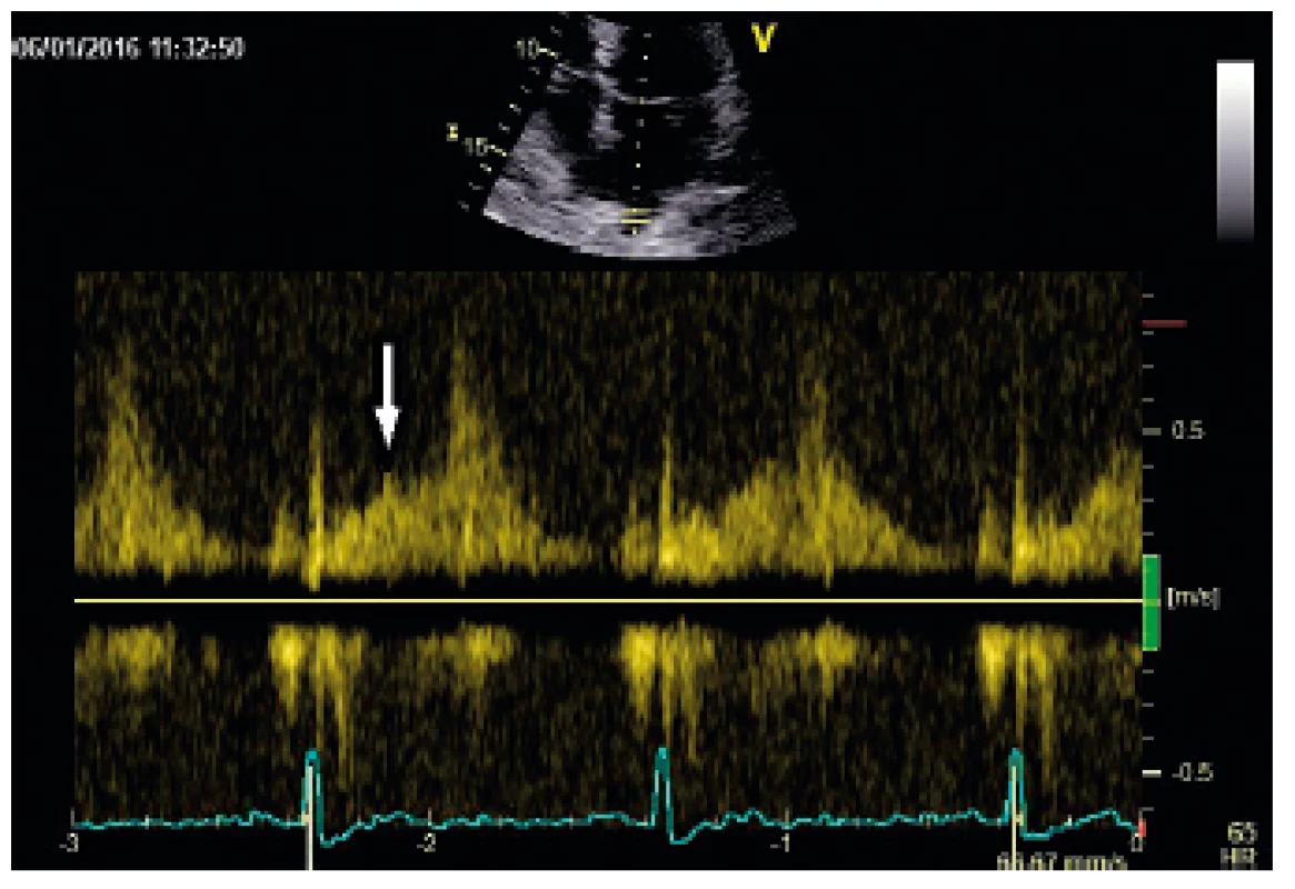 Záznam PW vyšetření průtoku pravou horní plicní žilou u pacienta se středně významnou MR
 – oploštělá vlna S (označena šipkou – odpovídá T vlně na záznamu EKG)