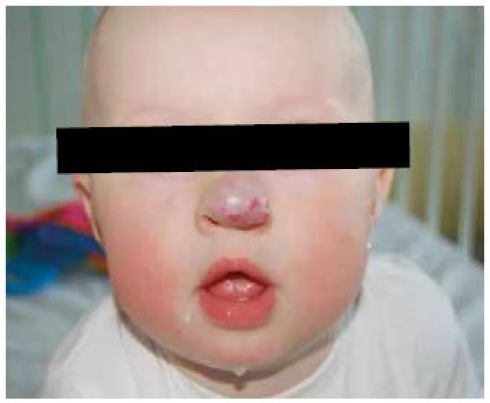 Kosmeticky závažný infantilní hemangiom špičky nosu.
Fig. 6. Severe infantile hemangioma on the tip of nose.
