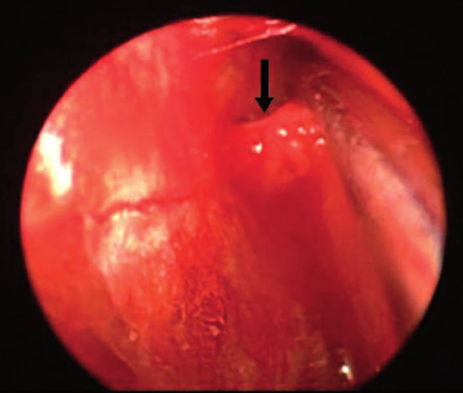 Peroperační endoskopický pohled na intraorbitální část a. ethmoidalis anterior před její koagulací.