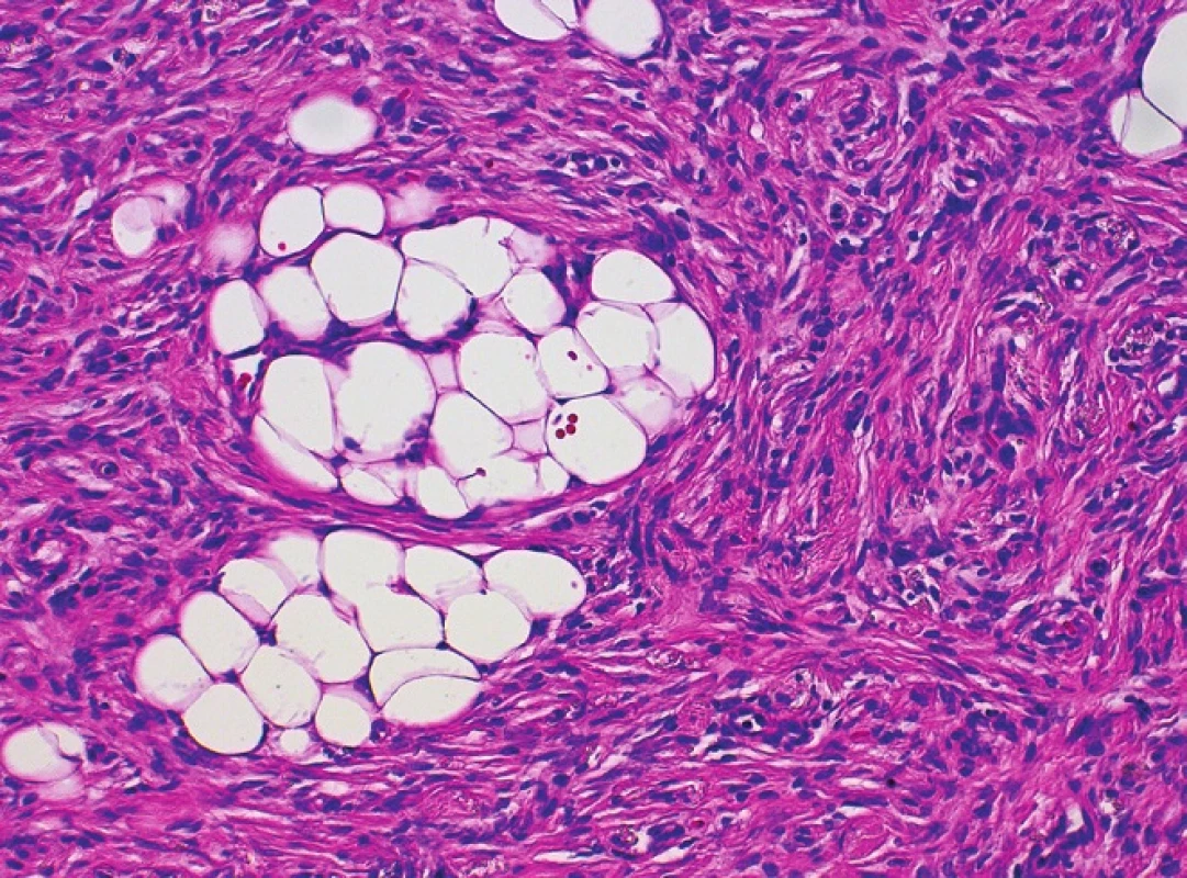 Detail nádorových vřetenitých fibroblastů, nodulární část, hematoxylin-eosin, 200krát