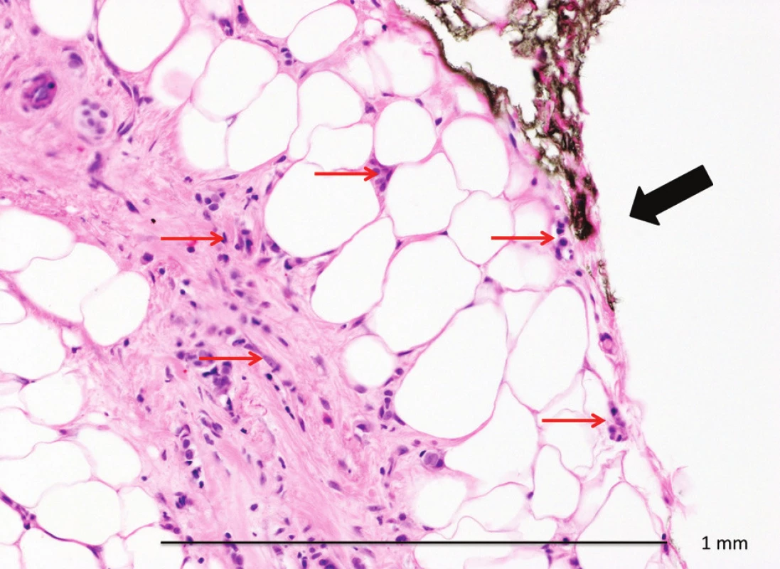 Invazivní lobulární karcinom v okraji resekátu (HEO 200x)
Fig. 1: Invasive lobulary carcinoma in the resection margin of the lumpectomy (HEO 200x) Tušovaný okraj resekátu (černá šipka), řádky a skupinky buněk invazivního lobulárního karcinomu gr. 1 ve vazivovém a tukovém stromatu, jednotlivé nádorové buňky v resekčním okraji (červené šipky). Pozitivní okraj s minimálním množstvím nádorových buněk, při reexcizi již karcinom nezastižen.