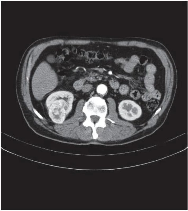 Tumor ledviny, CT snímek, arteriální fáze, axiální scan
Fig. 2. Renal tumor, CT image, arterial phase, axial scan