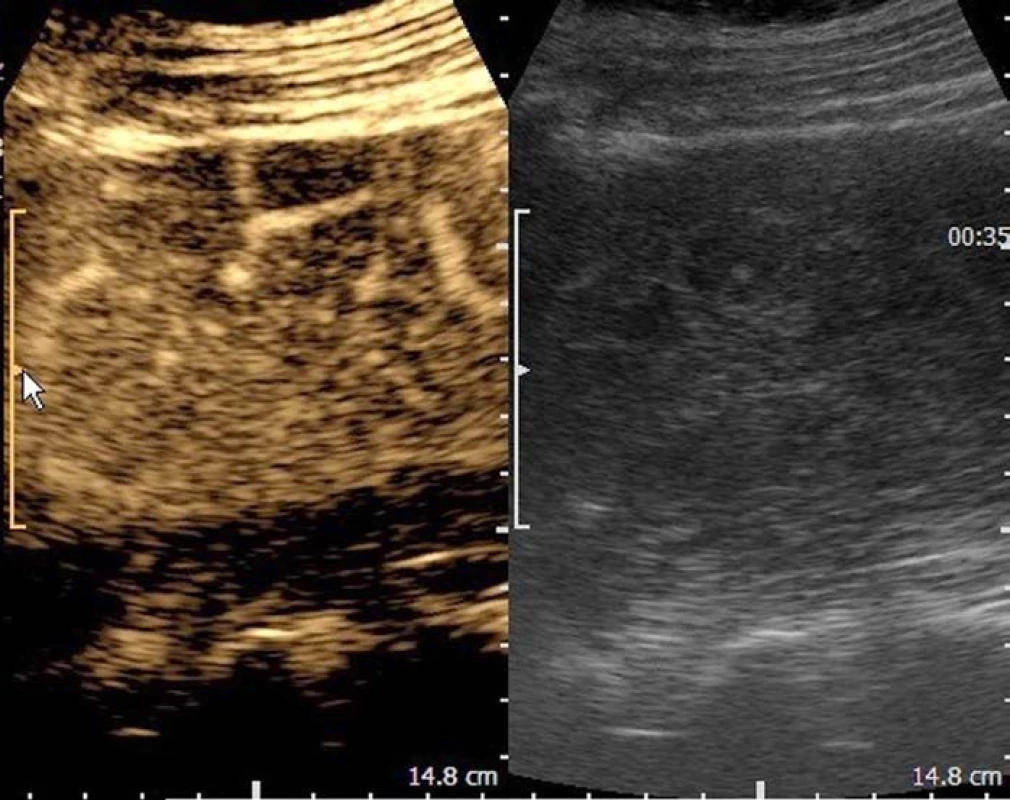Kontrastní harmonické zobrazení s patrnými intratumorálními cévami a konveční ultrazvukové zobrazení.