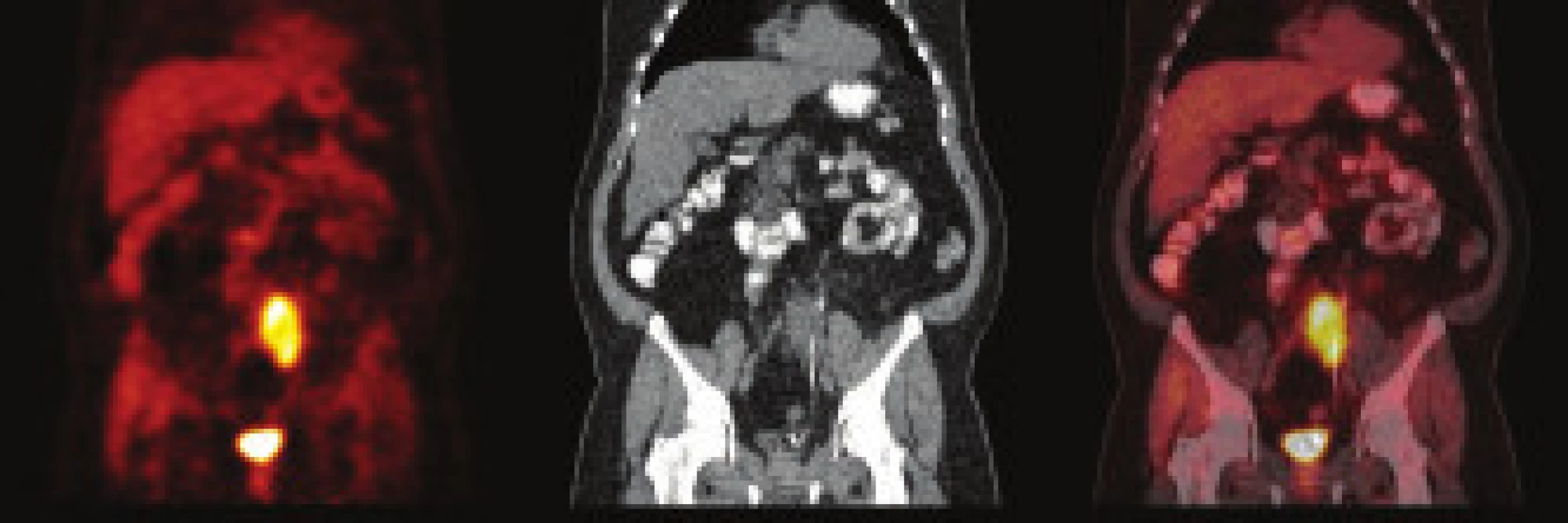 PET/CT pacienta – kazuistika 2. Stav před léčbou. Vysoká akumulace FDG se promítá do hypodenzní masy v retroperitoneu. Masou prochází ureter, do kterého je zaveden ureterální stent.