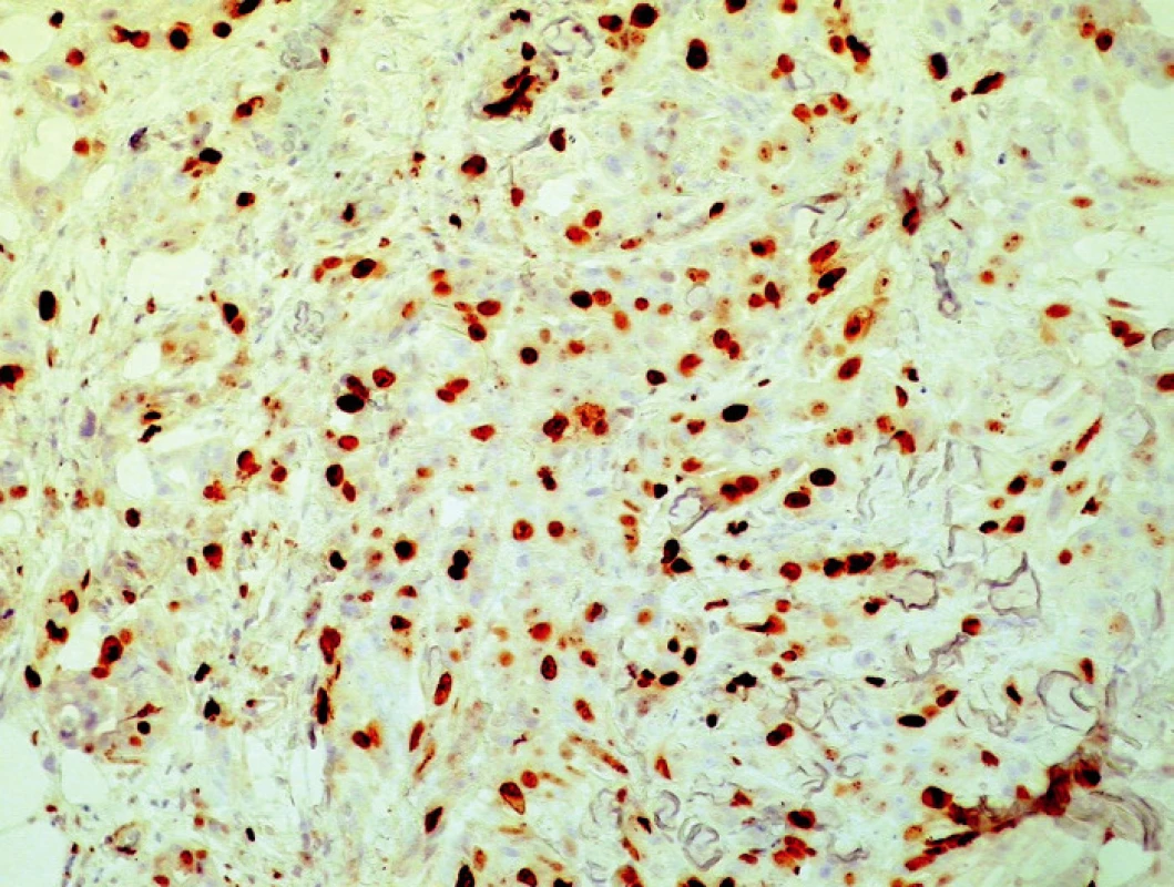 Histochemické vyšetření metastáz karcinomu prsu, proliferační markerMIB (200x).