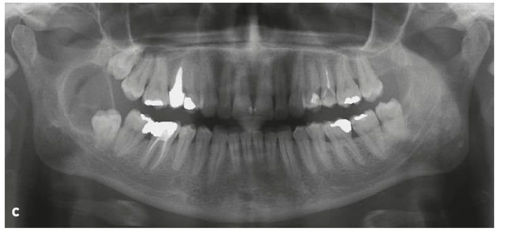 Nálezy při CBCT (a, b) a na ortopantomogramu (c) pacientky s laterální folikulární cystou v okolí retinovaného zubu 48
