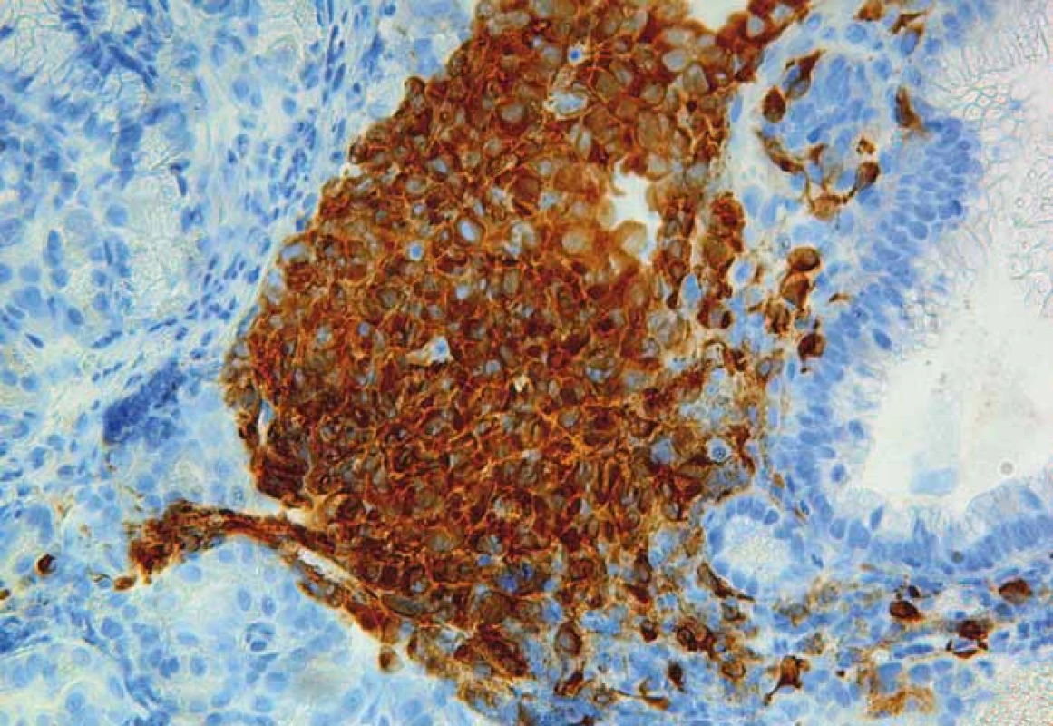 Žaludek, imunohistochemický průkaz exprese Melanu-A. Silná cytoplazmatická pozitivita 
v nádorových buňkách (zvětšení 200×).
Fig. 7. Stomach, immunohistochemical expression of Melan-A. Strong cytoplasmic positivity in the neoplastic cells is visible (original magnification ×200).