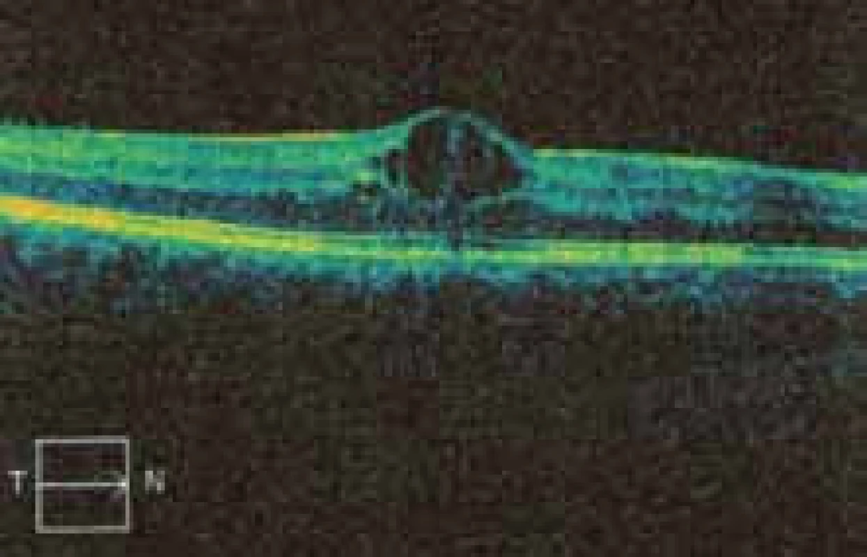 OCT scan makuly v 28. týdnu gravidity s cystoidní přestavbou.