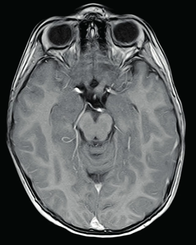 Gliom levého optického nervu, T1 postkontrastní zobrazení 
Fig. 1. Glioma of the left optic nerve, T1 postcontrast-enhanced