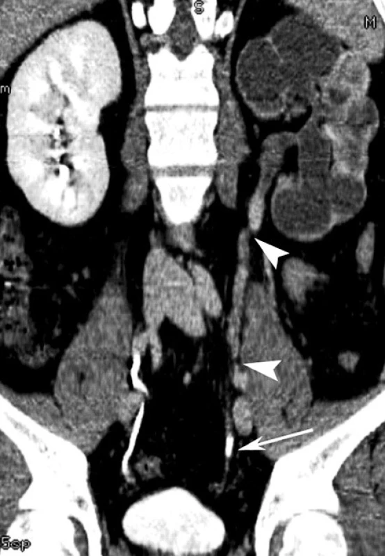 CT urogram – sagitální řez – tuberkulóza ledviny a močovodu vlevo; (střelky označují vícečetné strikutury močovodu, šipka)