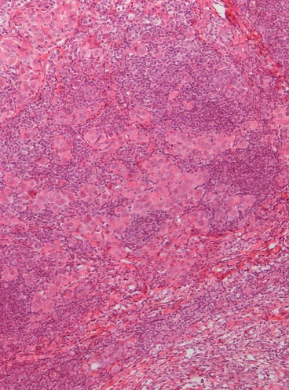 Duktální karcinom prsu s intenzivní stromální lymfocytární odpovědí – panoptické barvení.