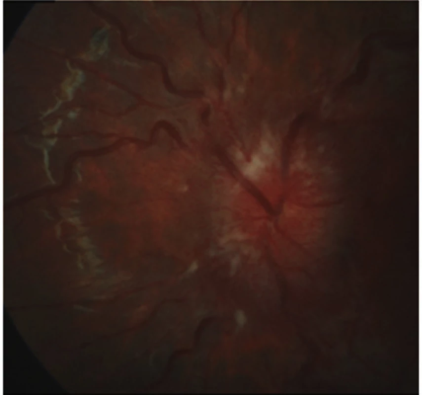 Terč zrakového nervu při prvním vyšetření na levém oku