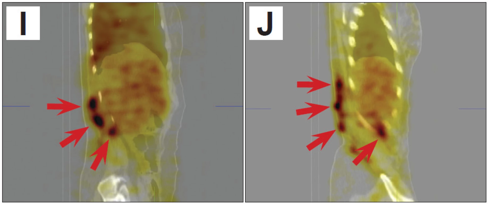 SPECT/CT obrazy trupu umožní přesnější posouzení lokalizace a rozsahu hemangiomu (šipky).
A 3D obraz v předním pohledu
B 3D obraz v pravém bočním pohledu
C 3D obraz v pravém zadním šikmém pohledu
D řez v transverzální rovině v dolní části hrudníku
E řez v transverzální rovině v úrovni beder
F řez v transverzální rovině v úrovni pánve
G řez ve frontální rovině dorzálně v oblasti páteře
H řez ve frontální rovině dorzálně v oblasti zadní stěny trupu
I řez v sagitální rovině parasagitálně od střední čáry vpravo
J řez v sagitální rovině laterálně vpravo