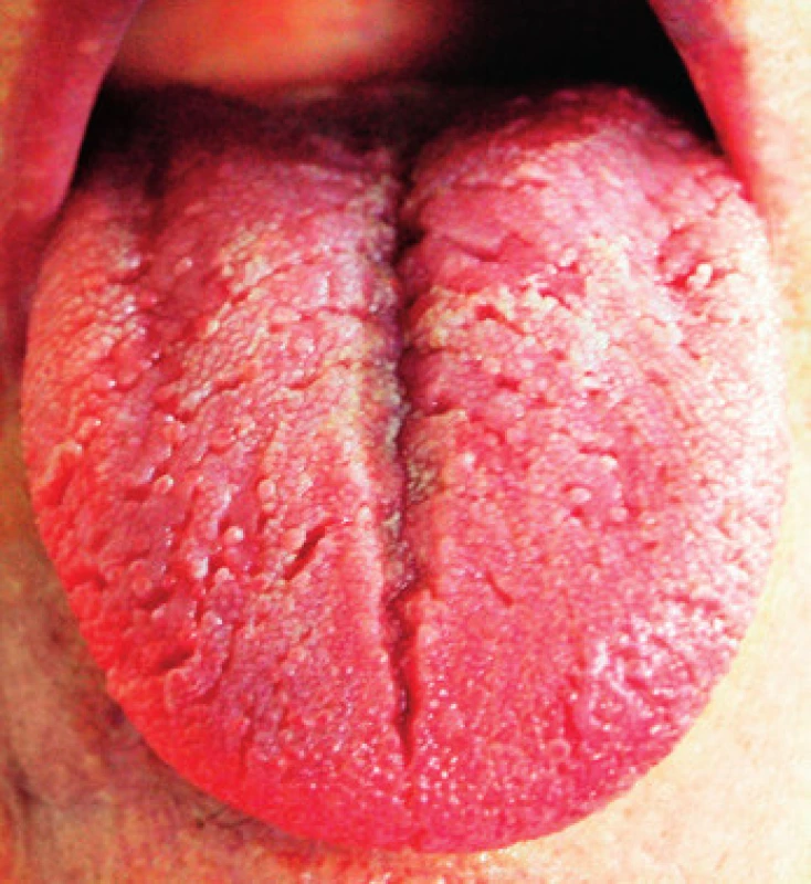 Výrazný a hlboký sulcus medianus, od neho periférne k bokom sú rôzne hlboké brázdy v povrchu jazyka
