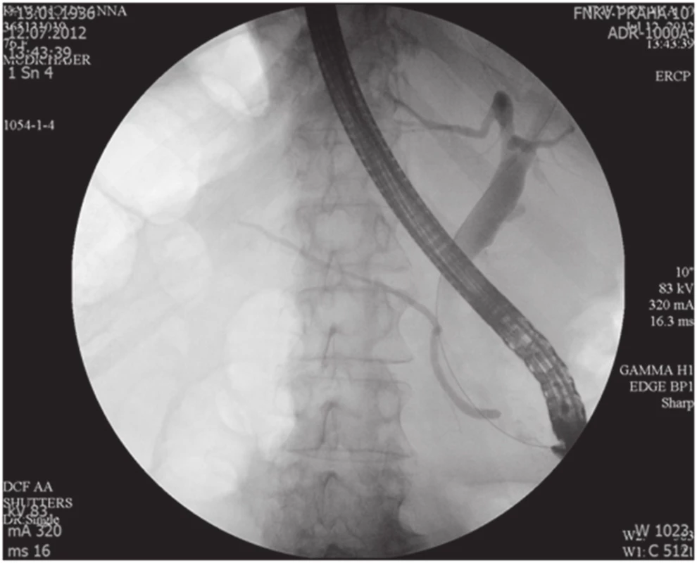 ERCP nález, normální Wirsung, dilatace HCH
Fig. 1. Normal ERCP finding, normal Wirsung duct, CBD dilatation
