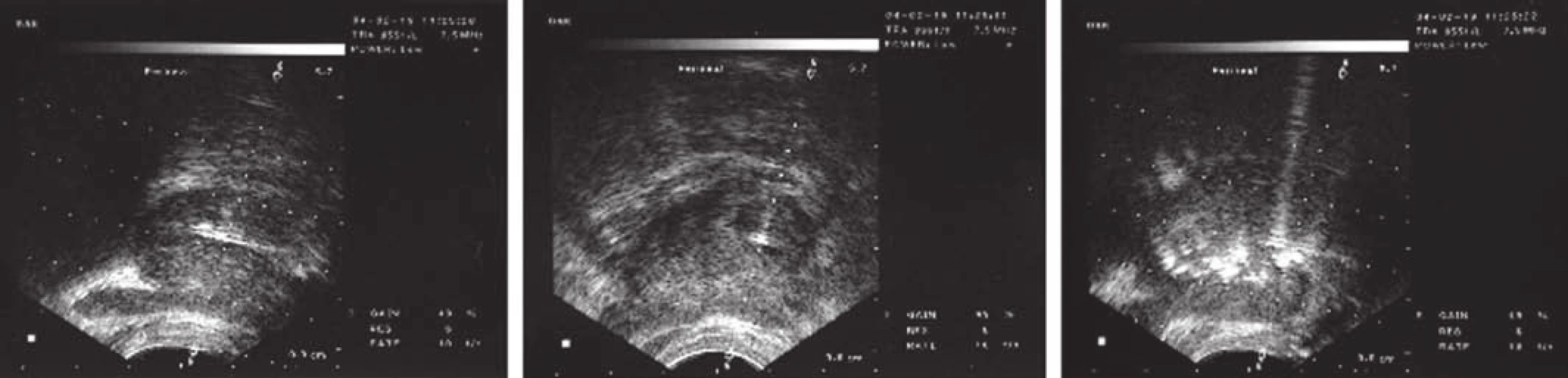 Vlevo: Potvrzení, že jehla (černá šipka) je zavedena do prostaty, podélné zobrazení. Uprostřed: Příčné zobrazení.
Vpravo: Difuze hyperechogenního BoNT (černá šipka) v prostatě bezprostředně po aplikaci. (Chuang a Chancellor 2006)